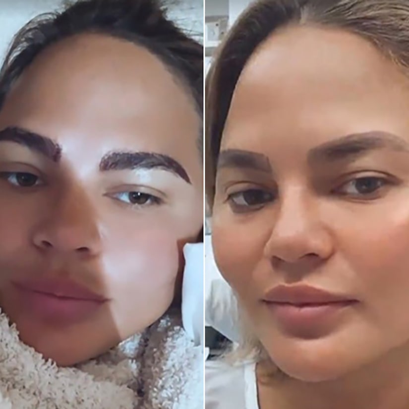 Chrissy Teigen shares the results of Eyebrow Transplant Surgery