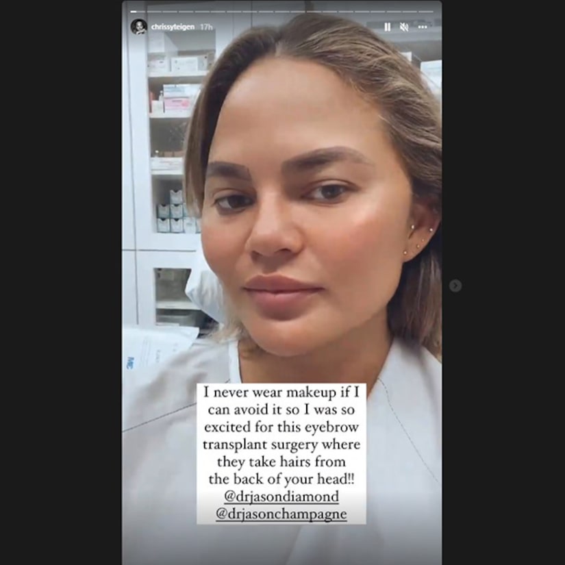 Chrissy Teigen shares the results of Eyebrow Transplant Surgery