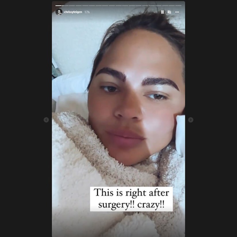 Chrissy Teigen shares the results of Eyebrow Transplant Surgery