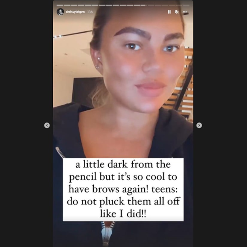 Chrissy Teigen shares the results of Eyebrow Transplant Surgery