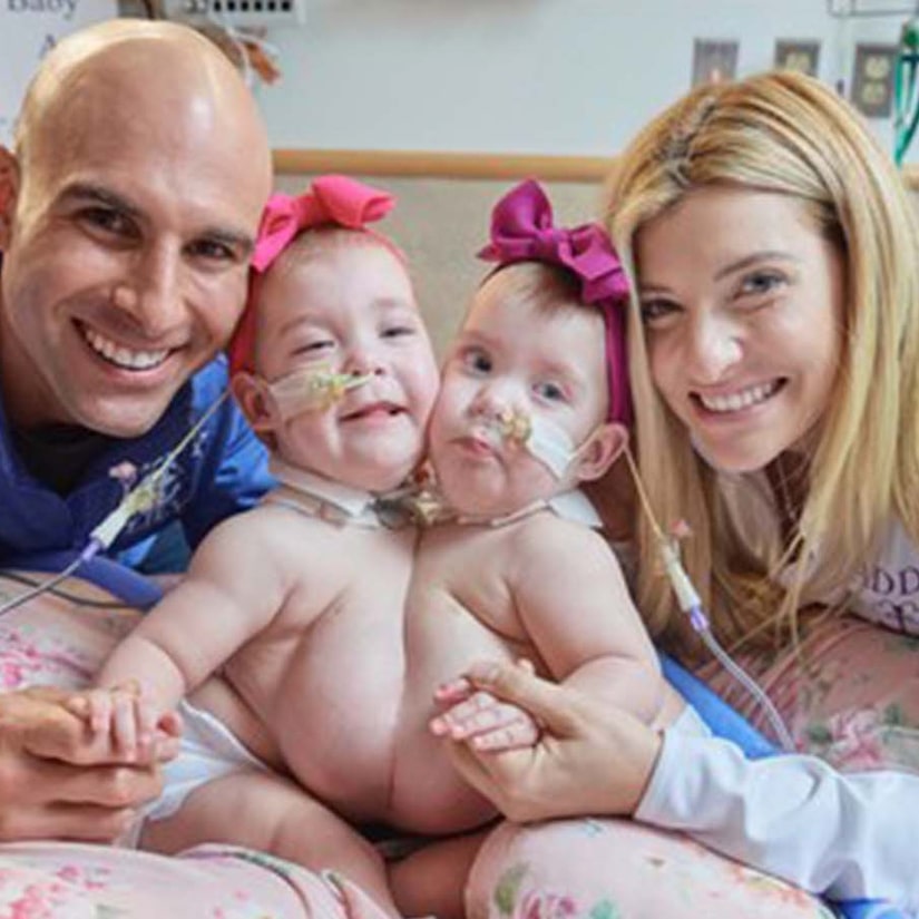 Philadelphia Surgeons Successfully Separate Twin Conjoined Girls from The Chest