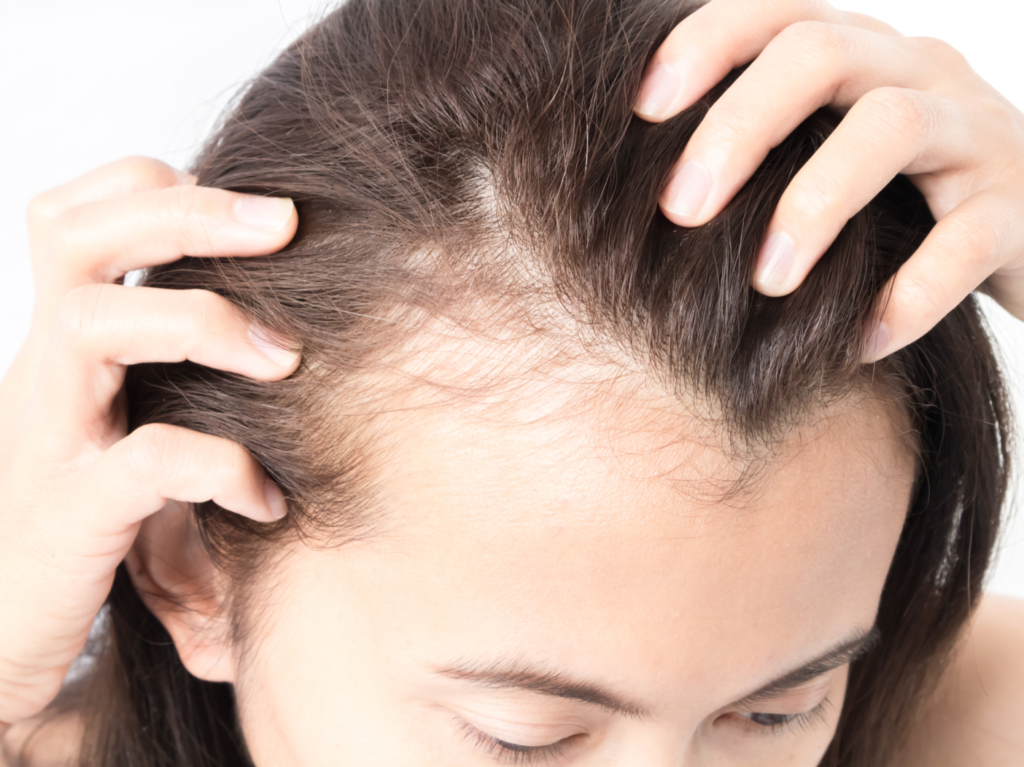 Woman serious hair loss problem for health care shampoo and beauty product