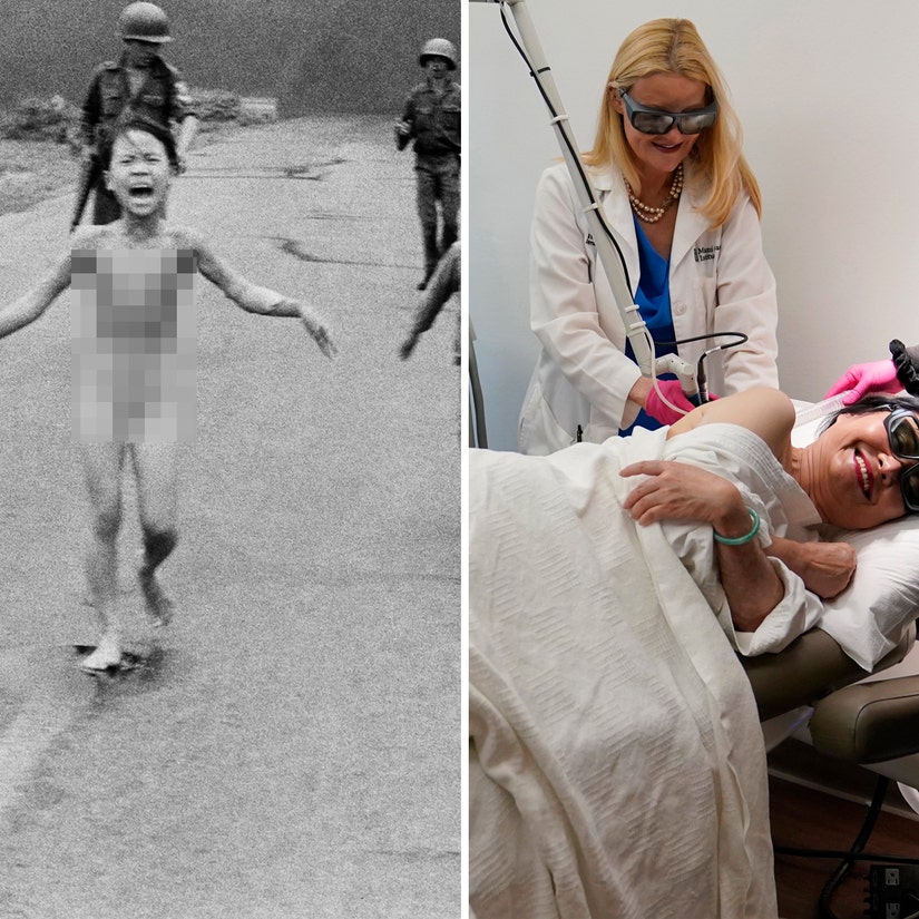 Kim Phuc, Vietnam War 'Napalm Girl,' Gets Final Burn Treatment 50 Years Later