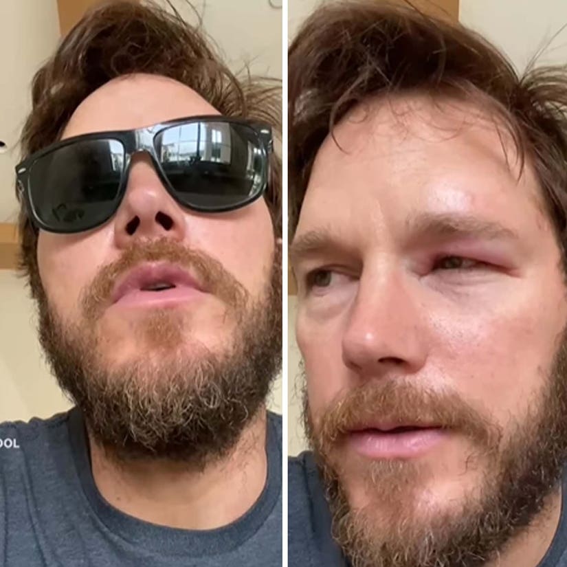 Chris Pratt Reveals Swollen Eye After Being Inspired By 'Bee Lady': 'F--k That'