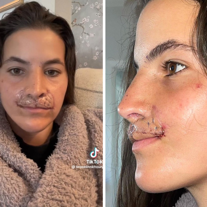 Brooklinn Khoury Shows Off Results of Latest Lip Reconstruction Surgery, Details Procedure