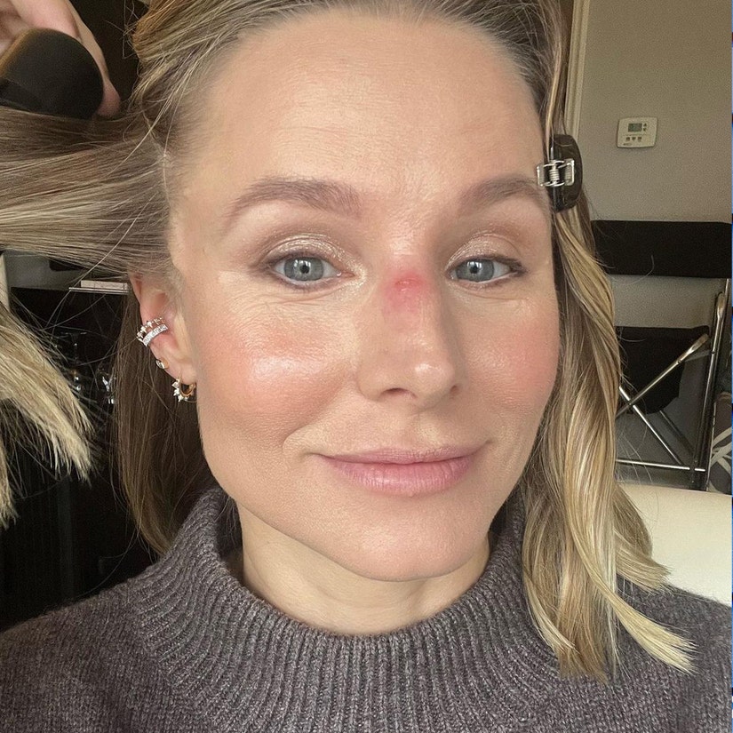 Kristen Bell Shares Jiu-Jitsu Nose Injury: 'You Should See The Other Guy'