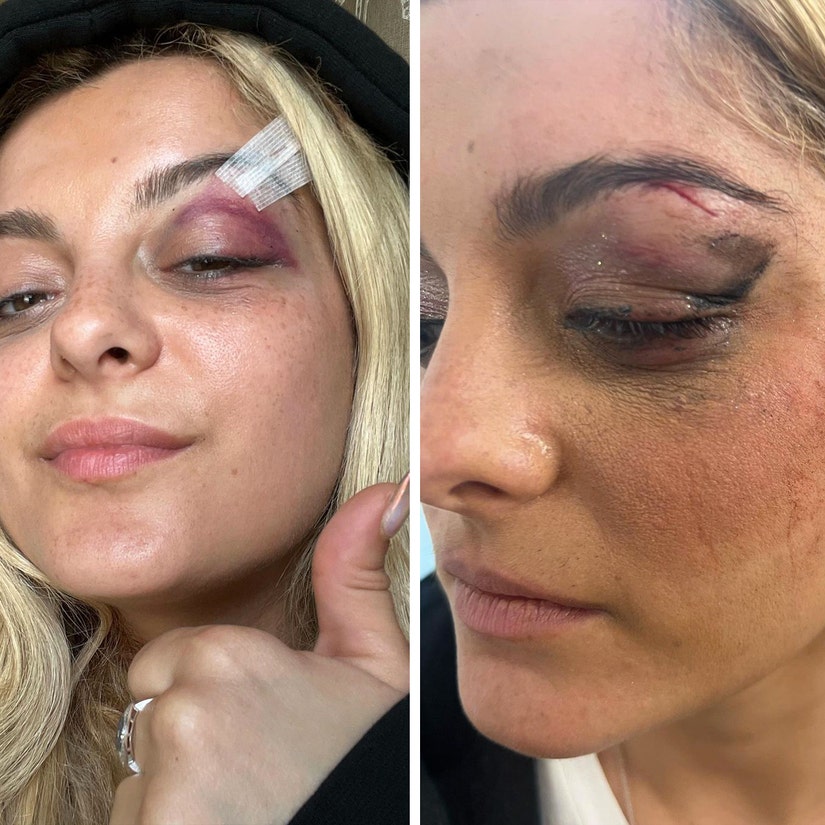 Bebe Rexha Shows Off Injuries After Being Hit with Cell Phone: 'I'm Good, Yeah, I'm Feelin' Alright'