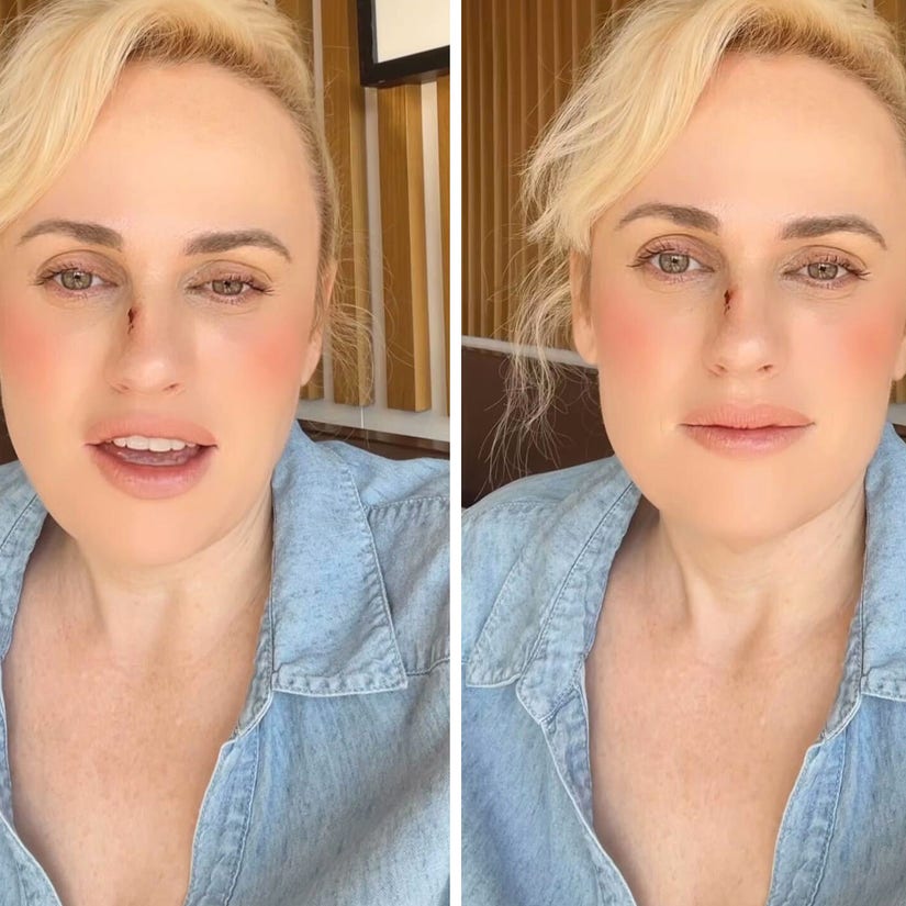 Rebel Wilson Details Stunt Accident That Sent Her to Hospital for Stitches